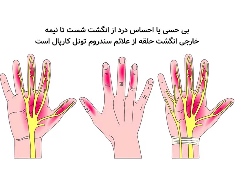 سندروم تونل کارپال