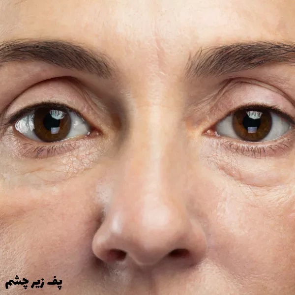 کاهش احتمالی پف زیر چشم
